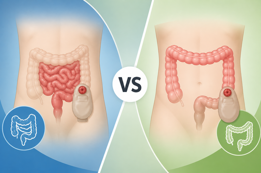 Ileostomy vs Colostomy: What Changes in Daily Life?